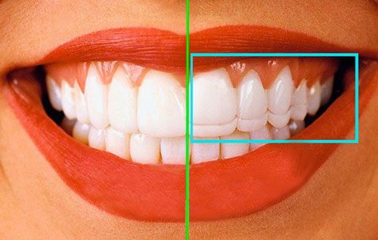 Лечение в области эстетической стоматологии